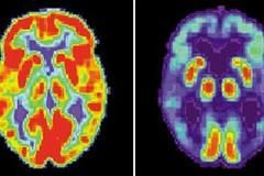 Objev českých vědců: Pomůže lidem s Alzheimerovou chorobou?