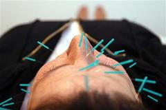 Akupunktura - ilustrační foto