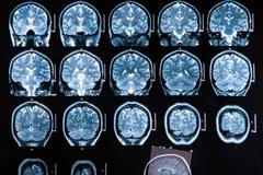 Alzheimer, Alzheimerova nemoc, Alzheimerova choroba, mozek, ilustrační foto