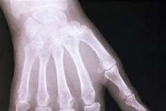 Artritida, zánětlivé onemocnění kloubů