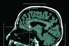 Mozek, mozkový nádor, ilustrační foto