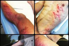 Koláž ze zranění biatlonisty Simona Fourcada