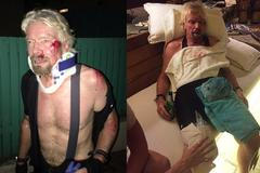 Miliardář Richard Branson po pádu z kola