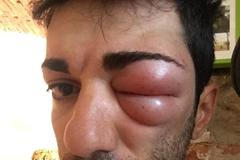 cyklistika, Danilo Celano po kousnutí od hmyzu