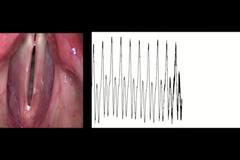Zachytí Parkinsona už v raném stadiu. Čeští vědci ho poznají z hlasu