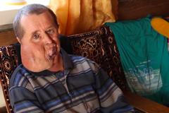 Rus žije 45 let s nádorem na obličeji. Při životě ho drží jeho děti a práce