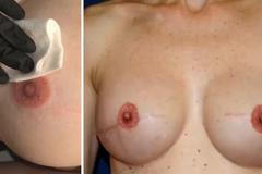 Vytetovat se dá i bradavka. Pacientám po rakovině prsu může pomoci i “kérka”