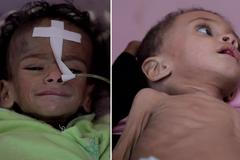 Otřesné záběry jemenských dětí. Kromě podvýživy mnohé trpí cholerou a záškrtem