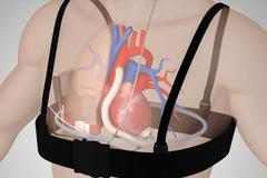 Muž žije s bezdrátovou srdeční elektropumpou