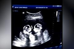 Boj o místo v děloze. “Hovory” dvojčat odhalil ultrazvuk