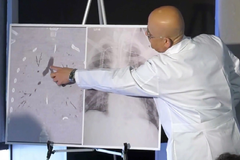 Rentgenové snímky plic chlapce, který podstoupil transplantaci (nalevo), a plic zdravého člověka