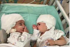 V Izraeli poprvé oddělili siamská dvojčata srostlá hlavami