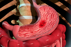 První příznaky - žaludeční vředy