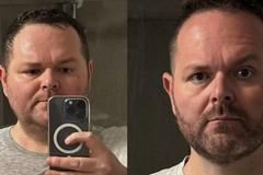 Obezitologícký pacient popisuje své zkušenosti (nejen) s lékem Mounjaro