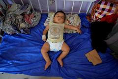 Palestinské dítě podvýživa