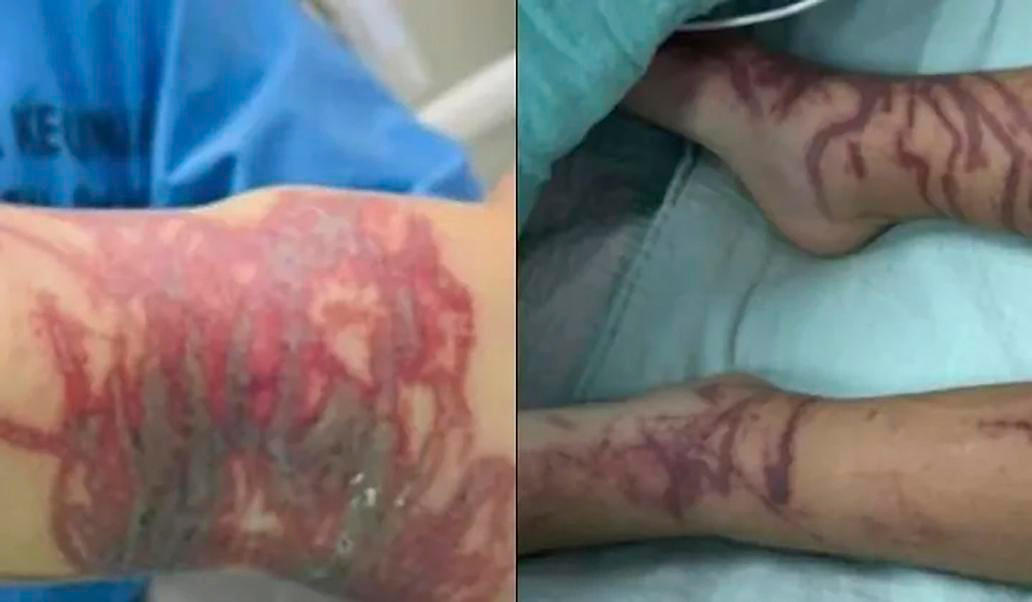 Chapadla čtyřhranek jsou pokryta miliony žahavých buněk, jejichž toxin dokáže během několika minut ochromit srdce i nervový systém. Popáleniny