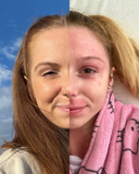 S atopickým ekzémem se Inka Teschinská potýká od raného dětství.