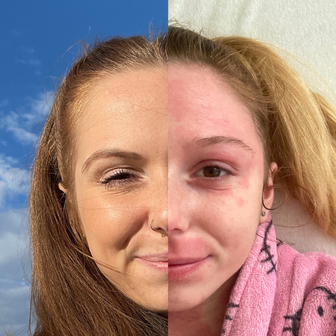 S atopickým ekzémem se Inka Teschinská potýká od raného dětství.