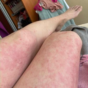 Ince začalo nejhorší období s ekzémem po dvacítce, kdy se její tělo potýkalo s infekcí a následnými antibiotiky.