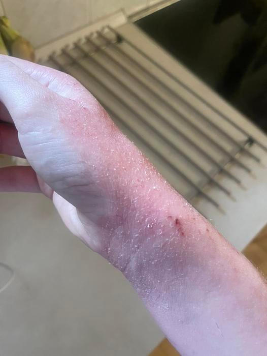 Atopický ekzém charakterizuje suchá kůže a svědění. Toto onemocnění se nepravidelně dědí a považuje se za chorobu svázanou s imunitními změnami.