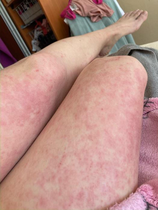 Ince začalo nejhorší období s ekzémem po dvacítce, kdy se její tělo potýkalo s infekcí a následnými antibiotiky.