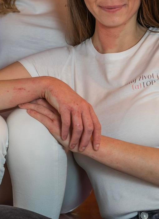 Dnes sdílí příběhy lidí s podobnou zkušeností, natáčí kampaně upozorňující na negativní účinky kortikosteroidů a šíří osvětu tam, kde podle ní dlouho chyběla.