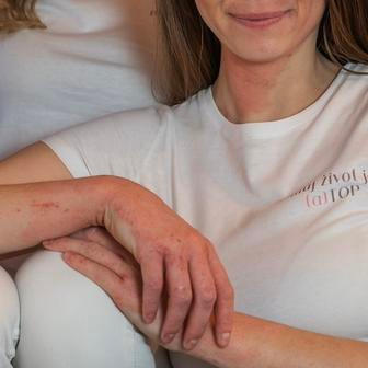 Dnes sdílí příběhy lidí s podobnou zkušeností, natáčí kampaně upozorňující na negativní účinky kortikosteroidů a šíří osvětu tam, kde podle ní dlouho chyběla.