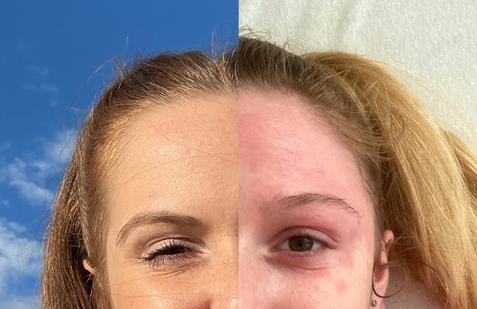 S atopickým ekzémem se Inka Teschinská potýká od raného dětství.