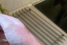 Atopický ekzém charakterizuje suchá kůže a svědění. Toto onemocnění se nepravidelně dědí a považuje se za chorobu svázanou s imunitními změnami.