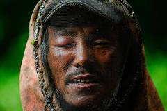 Sběrač medu se zraněným okem po bodnutí včel v Nepálu 2023.