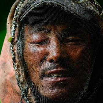 Sběrač medu se zraněným okem po bodnutí včel v Nepálu 2023.