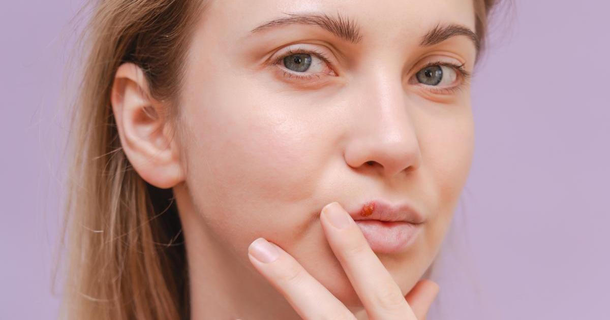 Opar není konec světa, ale existují osvědčené domácí triky, které mohou zmírnit vaše příznaky a zkrátit dobu trvání onemocnění.