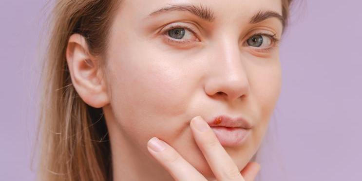 Opar není konec světa, ale existují osvědčené domácí triky, které mohou zmírnit vaše příznaky a zkrátit dobu trvání onemocnění.