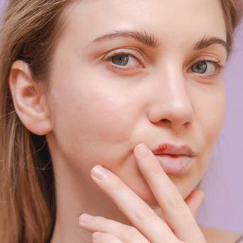 Opar není konec světa, ale existují osvědčené domácí triky, které mohou zmírnit vaše příznaky a zkrátit dobu trvání onemocnění.