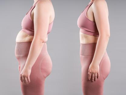 Tummy,Tuck,,Female,Fat,Body,Before,And,After,Weight,Loss