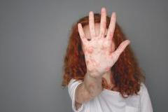 Spalničky nejsou jen „dětská vyrážka“. Mohou vést k zápalu plic, infekci mozku a v nejzávažnějších případech i k úmrtí. V roce 2025 tvořily 40 procent nemocných v Evropě děti mladší pěti let. 