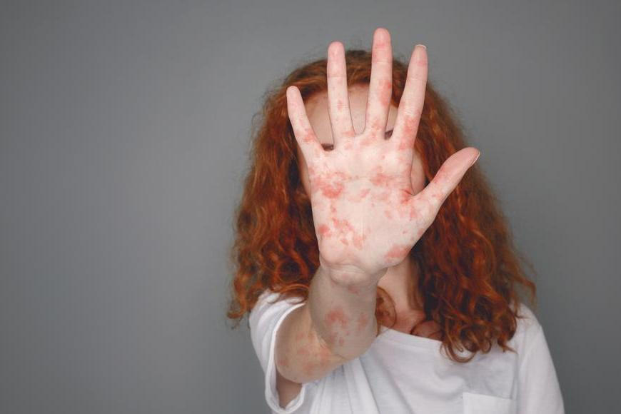 Signály, které není radno přehlížet: kašel, horečka a zarudnutí očí nejsou jarní klasika