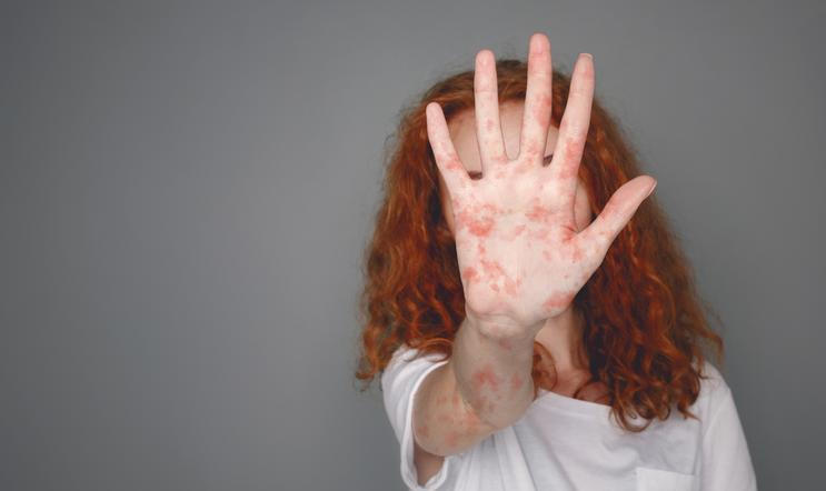 Spalničky nejsou jen „dětská vyrážka“. Mohou vést k zápalu plic, infekci mozku a v nejzávažnějších případech i k úmrtí. V roce 2025 tvořily 40 procent nemocných v Evropě děti mladší pěti let. 