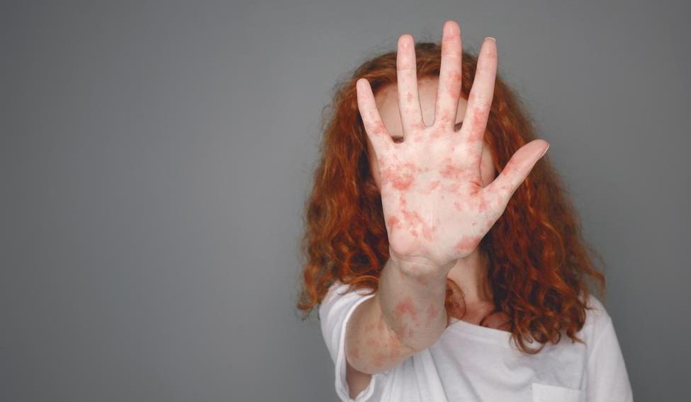 Spalničky nejsou jen „dětská vyrážka“. Mohou vést k zápalu plic, infekci mozku a v nejzávažnějších případech i k úmrtí. V roce 2025 tvořily 40 procent nemocných v Evropě děti mladší pěti let. 