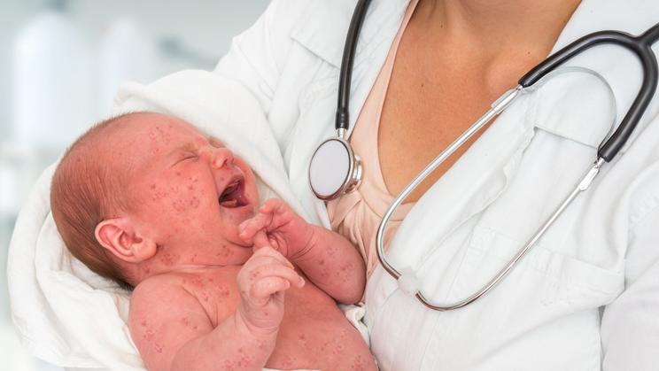 Evropa zažívá návrat spalniček, nemoci, kterou mnozí považovali za téměř vymýcenou. Ilustrační foto