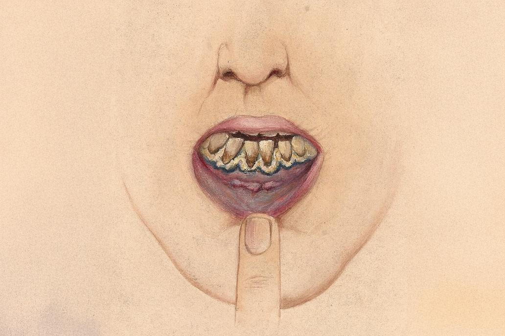 Ilustrační vizuální zobrazení změn v oblasti úst, které připomínají tzv. Burtonovu linii — tenký tmavý okraj na rozhraní dásní a zubů popisovaný u chronické otravy olovem. Tento příznak vzniká ukládáním sulfidu olovnatého v dásňové tkáni a byl jedním z vodítek, která v 70. letech upozornila lékaře na saturnismus u dětí ze Szopienic. Snímek slouží jako obecná ilustrace mechanismu zbarvení dásní, nikoli jako dokumentace konkrétního pacienta.