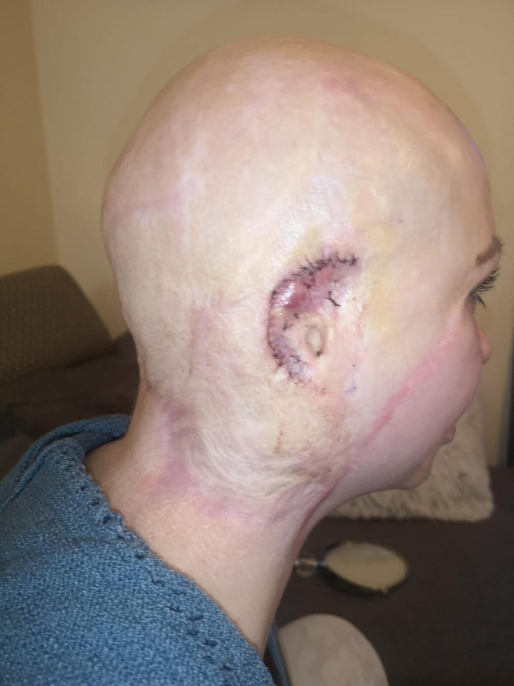 Anna si zpočátku vůbec nepřipouštěla, jak vážně je zraněná. Až po operaci jí postupně došlo, jak rozsáhlé následky nehoda měla. EXCLUSIVE: ‘I had the hair ripped from my scalp in horror workplace accident and now my kids struggle to recognise me’