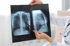 Lung,Disease.,Doctor,Examining,Chest,X-ray,In,Clinic,,Closeup