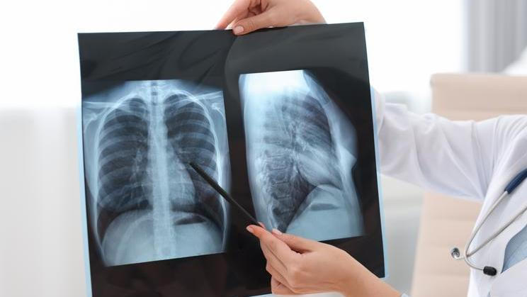 Lung,Disease.,Doctor,Examining,Chest,X-ray,In,Clinic,,Closeup
