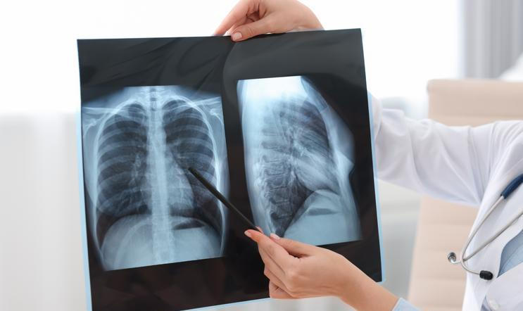 Lung,Disease.,Doctor,Examining,Chest,X-ray,In,Clinic,,Closeup