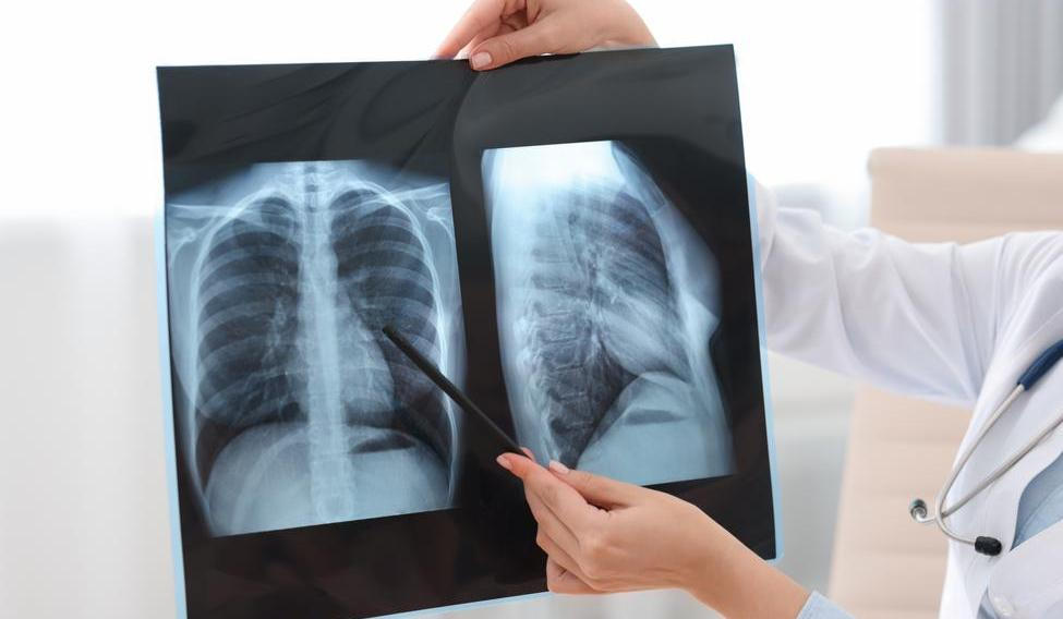 Lung,Disease.,Doctor,Examining,Chest,X-ray,In,Clinic,,Closeup