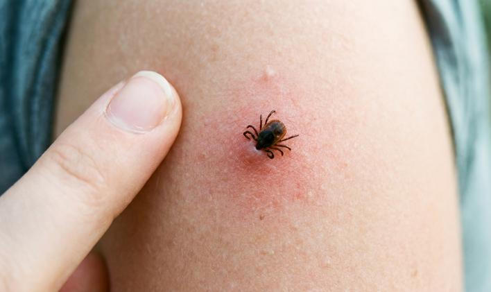 A,Close,Up,Shot,Of,A,Tick,Attached,To,Human