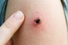 A,Close,Up,Shot,Of,A,Tick,Attached,To,Human