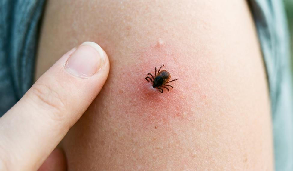 A,Close,Up,Shot,Of,A,Tick,Attached,To,Human