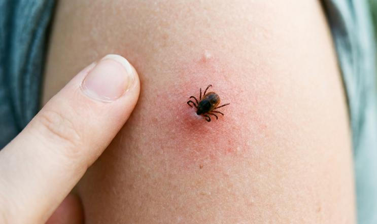 A,Close,Up,Shot,Of,A,Tick,Attached,To,Human
